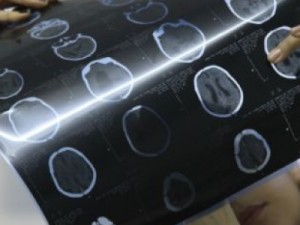 Brasil tem 1.761 casos suspeitos de microcefalia e investiga 19 mortes