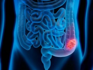 Câncer colorretal é o terceiro mais frequente entre os homens