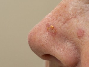 Câncer de pele: causas, sintomas, tipos, tratamento e prevenção