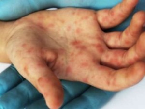 Casos de sarampo chegam 10 mil, diz Ministério da Saúde