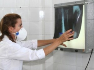 Cerca de 200 pessoas morrem anualmente no Ceará por tuberculose