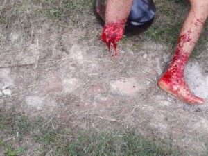 Drástico: Acidente deixa motoqueiro com perna amputada, em Caucaia