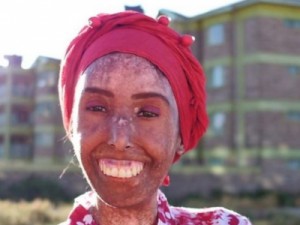 Esclerodermia, uma terrível doença de pele - Veja