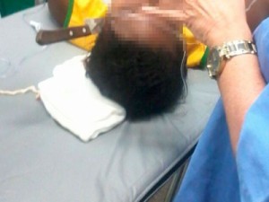 Jovem de 23 anos tem faca cravada na cabeça durante briga e sobrevive