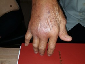 Médico barbalhense publica pesquisa pioneira no mundo sobre o tratamento da artrite da Chikungunya