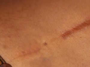 Moléculas têm potencial para acelerar processo de cicatrização da pele