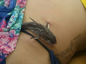 Mulher fica com peixe preso próximo à barriga e Samu é acionado: 'Inédito'