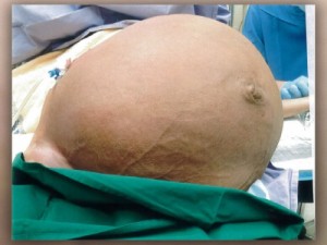 Mulher fica sem respirar por causa de tumor enorme de 27 kg na barriga