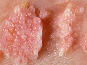 O HPV pode provocar lesões genitais de alto risco