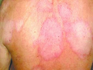 O que é hanseníase e quais os sintomas?