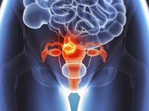 Os 10 principais sintomas de câncer que toda mulher precisa saber