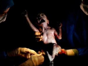 Os primeiros segundos de bebês nascidos por cesárea