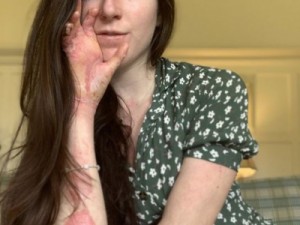 'Pele de borboleta': a dolorosa doença que causa dores e ferimentos e pode levar à morte