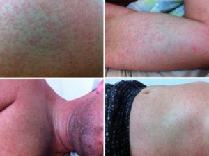 Secretaria de Saúde confirma surto de doença misteriosa na Paraíba