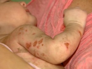 Sintoma de chikungunya em bebês é similar a queimaduras de 1º e 2º graus