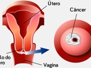 Sintomas de câncer de colo de útero