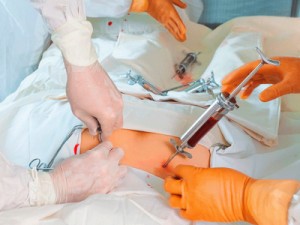 Transplante de medula óssea, conheça tudo