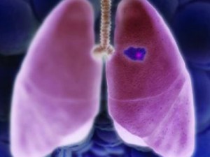 Uma em cada seis mulheres do mundo desenvolve câncer de pulmão