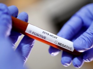 Coronavíruas atualizados: Ceará tem 5 mortes e 382 casos