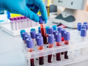 Covid-19: Dados atualizados de Barbalha, Crato, Juazeiro, Ceará e Brasil