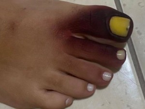 Carioca fica com pé roxo e unha amarela ao calçar tênis com piolho-de-cobra