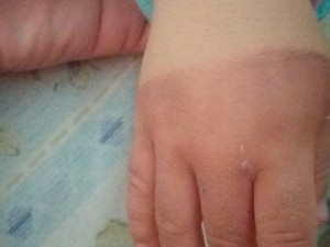 Mãe denuncia babás por maus-tratos após bebê de 1 ano ter mão queimada, em MS