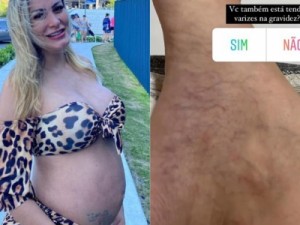 Grávida, Andressa Urach mostra varizes no pé: "Apavorada"