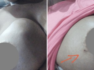 Mulher relata ‘seio torto’ após tratar com médico preso