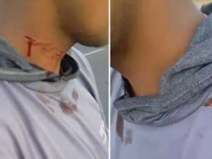 Motociclista tem pescoço cortado por linha com cerol no Ceará: 'Salvo por um milagre'