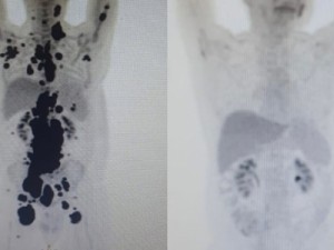 Anvisa autoriza pesquisa clínica com Car-T Cell no Brasil; paciente teve remissão completa de câncer