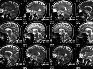 Alzheimer, a nova era: drogas inovadoras e estudos ampliam ferramentas para atacar demências