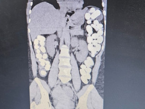 Mulher dá entrada em pronto-socorro com crise convulsiva, e exame encontra cápsulas com drogas no intestino