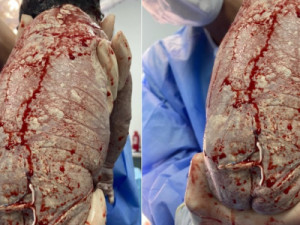 Mãe engravida com DIU e bebê nasce com dispositivo colado ao corpo, no DF