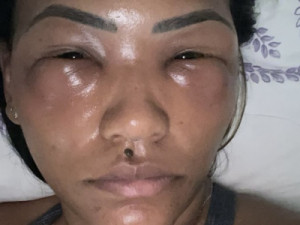 ‘Preenchi as olheiras e, por erro da profissional, meus olhos ficaram inchados e roxos; tive uma inflamação grave e precisei tirar o ácido’