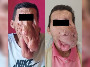 Cirurgia retira 700g de tumores do rosto de homem com doença rara em SC: ‘Voltei a comer melhor’