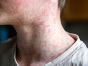 Surto de sarampo em país vizinho preocupa o Brasil; saiba quem precisa se vacinar e quais são os sintomas