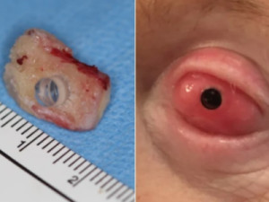 Paciente cego tem dente implantado em olho e volta a enxergar