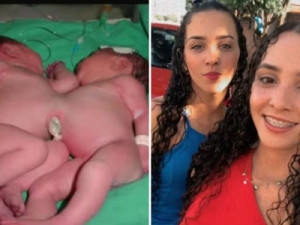 Raniela e Rafaela: Saiba como vivem gêmeas que nasceram unidas pelo abdômen e passaram por cirurgia de separação em 2002