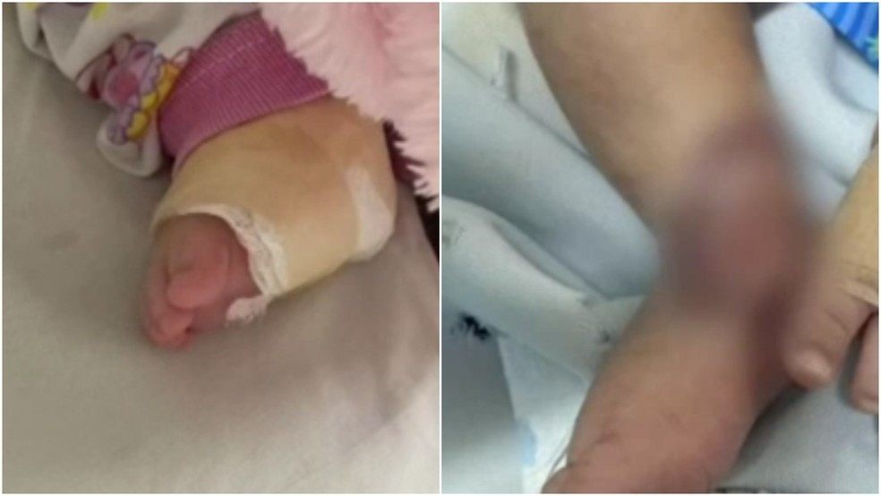 Bebê tem ferimento grave após injeção em hospital no Ceará; família cita negligência