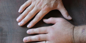 Angioedema: o que é, sintomas, causas, tipos e tratamento