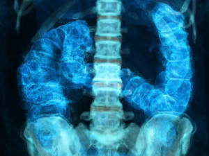 Diagnóstico precoce pode curar mais de 90% dos casos de câncer de intestino; veja os sinais de alerta