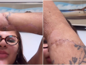 Mulher que teve mãos amputadas pelo ex mostra cicatrizes pela 1ª vez após reimplante: 'marcas do meu milagre'