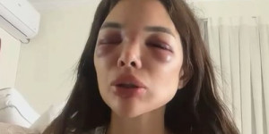 Dentista é agredida por empresário da Faria Lima; vítima relata episódio: 'tentou me matar'